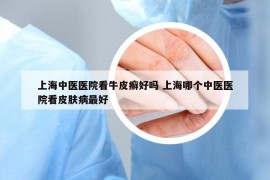 上海中醫(yī)醫(yī)院看牛皮癬好嗎 上海哪個中醫(yī)醫(yī)院看皮膚病最好