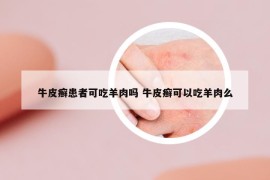 牛皮癬患者可吃羊肉嗎 牛皮癬可以吃羊肉么