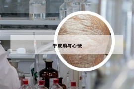 牛皮癬與心梗
