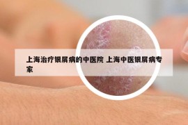 上海治療銀屑病的中醫(yī)院 上海中醫(yī)銀屑病專家