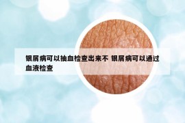 銀屑病可以抽血檢查出來不 銀屑病可以通過血液檢查