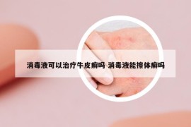 消毒液可以治療牛皮癬嗎 消毒液能擦體癬嗎