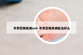 尋常型銀屑病uvb 尋常型銀屑病能治好么