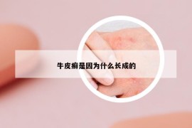 牛皮癬是因?yàn)槭裁撮L(zhǎng)成的