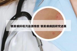 銀屑病環(huán)境污染源橡膠 銀屑病病因研究進(jìn)展