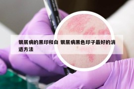 銀屑病的黑印和白 銀屑病黑色印子最好的消退方法