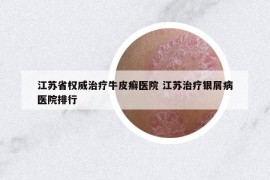 江蘇省權(quán)威治療牛皮癬醫(yī)院 江蘇治療銀屑病醫(yī)院排行
