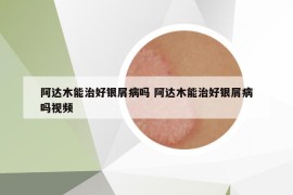 阿達(dá)木能治好銀屑病嗎 阿達(dá)木能治好銀屑病嗎視頻