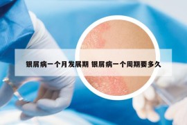 銀屑病一個(gè)月發(fā)展期 銀屑病一個(gè)周期要多久