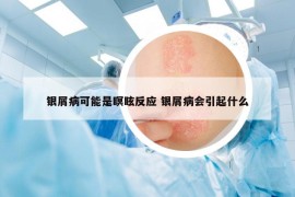 銀屑病可能是瞑眩反應(yīng) 銀屑病會(huì)引起什么