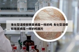 角化型濕疹和銀屑病是一樣的嗎 角化型濕疹和銀屑病是一樣的嗎圖片