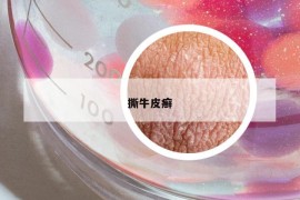 撕牛皮癬
