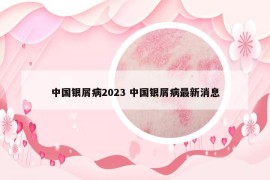中國銀屑病2023 中國銀屑病最新消息