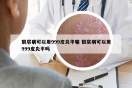 銀屑病可以用999皮炎平嘛 銀屑病可以用999皮炎平嗎