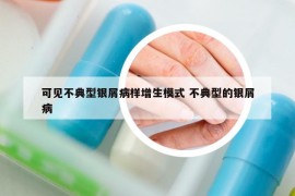 可見不典型銀屑病樣增生模式 不典型的銀屑病