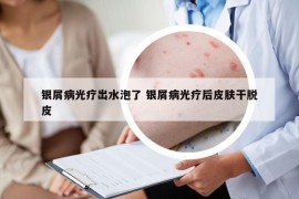 銀屑病光療出水泡了 銀屑病光療后皮膚干脫皮