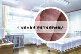 牛皮癬土辦法 治療牛皮癬的土秘方
