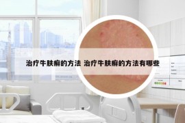 治療牛膚癬的方法 治療牛膚癬的方法有哪些