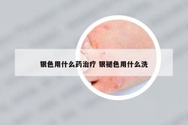 銀色用什么藥治療 銀褪色用什么洗