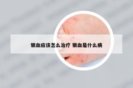銀血應(yīng)該怎么治療 銀血是什么病