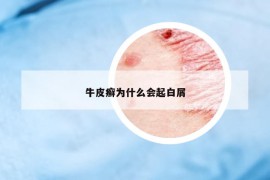 牛皮癬為什么會(huì)起白屑