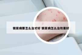 銀屑病要怎么治才好 銀屑病怎么治效果好