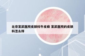 北京宣武醫(yī)院皮膚科牛皮癬 宣武醫(yī)院的皮膚科怎么樣