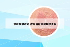 銀屑病甲激光 激光治療銀屑病很貴嘛