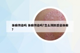 體癬傳染嗎 體癬傳染嗎?怎么預(yù)防感染體癬?