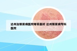 達(dá)州治銀屑病醫(yī)院哪家最好 達(dá)州銀屑病?？漆t(yī)院