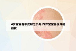 4歲寶寶有牛皮癬怎么辦 四歲寶寶得皮炎的癥狀