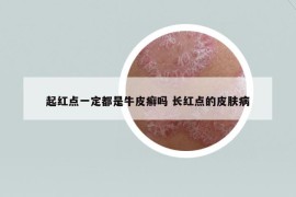 起紅點一定都是牛皮癬嗎 長紅點的皮膚病
