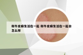 和牛皮癬生活在一起 和牛皮癬生活在一起會(huì)怎么樣