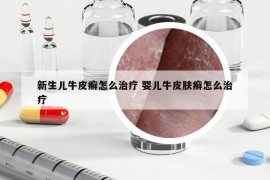 新生兒牛皮癬怎么治療 嬰兒牛皮膚癬怎么治療