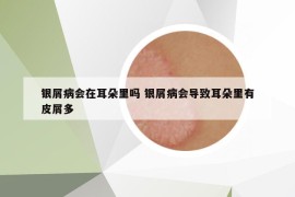 銀屑病會在耳朵里嗎 銀屑病會導致耳朵里有皮屑多