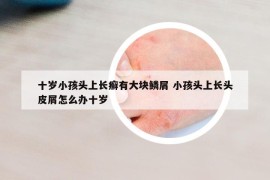 十歲小孩頭上長(zhǎng)癬有大塊鱗屑 小孩頭上長(zhǎng)頭皮屑怎么辦十歲