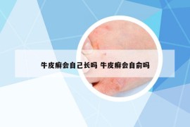 牛皮癬會(huì)自己長嗎 牛皮癬會(huì)自俞嗎