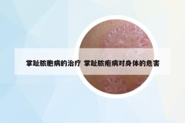 掌趾膿胞病的治療 掌趾膿皰病對身體的危害