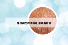 牛皮癬怎樣清肺毒 牛皮癬肺炎