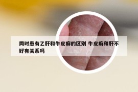 同時(shí)患有乙肝和牛皮癬的區(qū)別 牛皮癬和肝不好有關(guān)系嗎