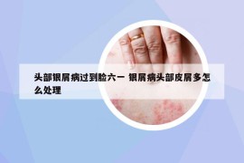 頭部銀屑病過到臉六一 銀屑病頭部皮屑多怎么處理