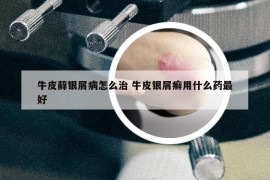 牛皮蘚銀屑病怎么治 牛皮銀屑癬用什么藥最好