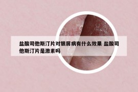 鹽酸司他斯汀片對銀屑病有什么效果 鹽酸司他斯汀片是激素嗎