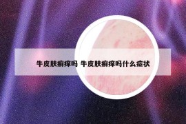 牛皮膚癬癢嗎 牛皮膚癬癢嗎什么癥狀