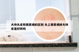 大塊頭皮和銀屑病的區(qū)別 頭上銀屑病掉大塊皮是好轉(zhuǎn)嗎