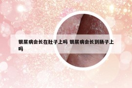銀屑病會(huì)長(zhǎng)在肚子上嗎 銀屑病會(huì)長(zhǎng)到腸子上嗎