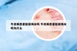 牛皮癬患者能碰海水嗎 牛皮癬患者能碰海水嗎為什么