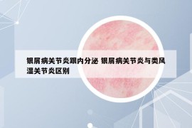 銀屑病關(guān)節(jié)炎跟內(nèi)分泌 銀屑病關(guān)節(jié)炎與類風(fēng)濕關(guān)節(jié)炎區(qū)別