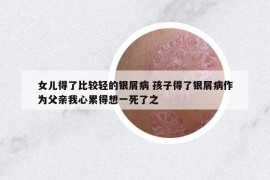 女兒得了比較輕的銀屑病 孩子得了銀屑病作為父親我心累得想一死了之