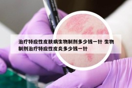 治療特應性皮膚病生物制劑多少錢一針 生物制劑治療特應性皮炎多少錢一針